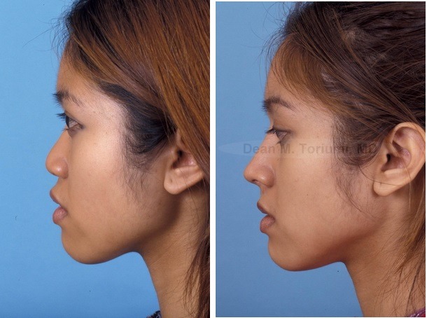 아시안여자코수술 드라마틱하다 | 인스티즈