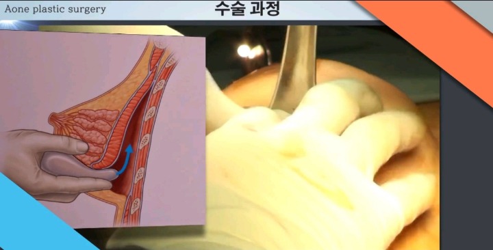 보형물 이용한 가슴성형.jpg (사진주의) | 인스티즈