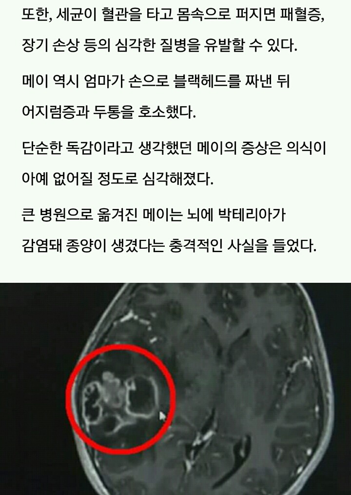 '위험 삼각형' 부분에 난 '블랙헤드' 짰다가 뇌종양 생긴 10세 소녀 | 인스티즈